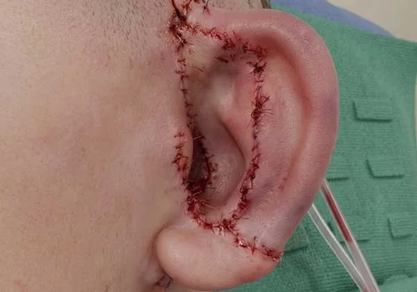 A close-up surgical photo shows a reconstructed ear immediately after Medpor microtia surgery, with different color skin grafts secured by sutures covering the visible surface of the ear. The extensive suture lines outline the newly shaped ear structure created during the Medpor implant procedure.