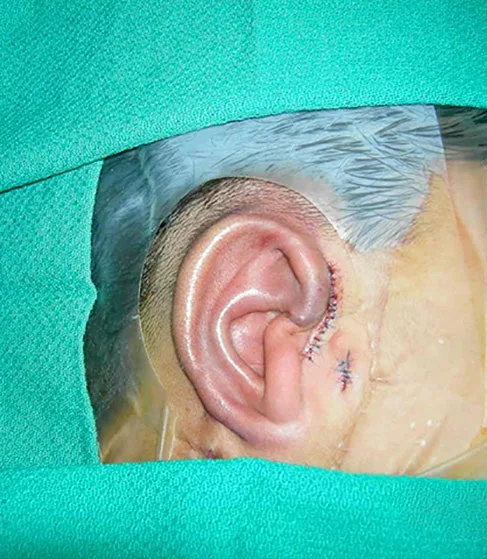 First stage microtia ear reconstruction result showing carved rib cartilage framework placed under the skin