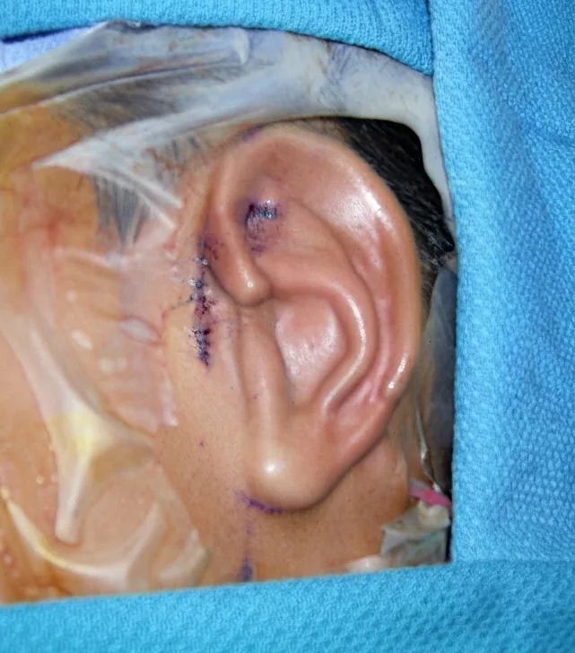 Result immediately after Stage 1 microtia reconstruction by Dr. Arturo Bonilla in San Antonio — the hand-carved rib cartilage ear framework in place with the earlobe rotated into position, the tragus formed, and the concha deepened, all completed in a single first surgery