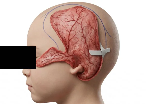 A detailed anatomical rendering shows the full size of the large temporoparietal fascia flap lifted from the scalp, revealing its extensive blood vessel network and how it drapes down over the ear framework. This illustration shows why the fascia flap is a critical tissue layer used in microtia reconstruction to provide blood supply and coverage to the cartilage framework.