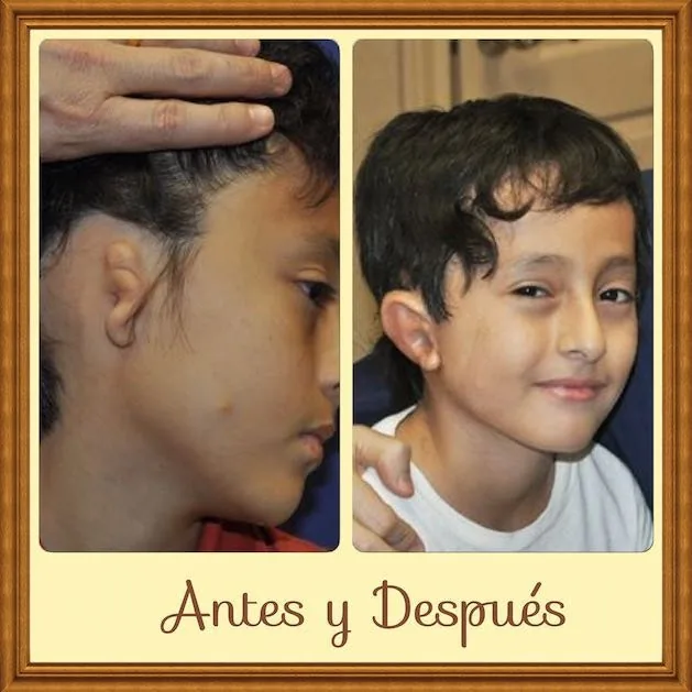 Collage enmarcado de fotografías de antes y después, con textos en español y el rótulo «Antes y Después», que muestra la oreja de un niño antes de la cirugía de microtia y su rostro alegre y sonriente después de una reconstrucción de oreja exitosa: un poderoso homenaje visual a la cirugía de microtia del Dr. Arturo Bonilla que cambia vidas, de la familia de un paciente agradecido