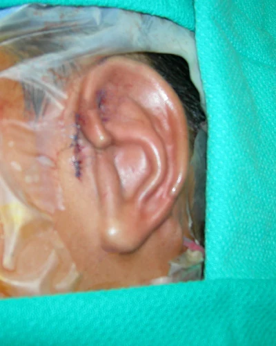 Close-up clinical photograph showing the result of Stage 1 microtia reconstruction by Dr. Arturo Bonilla in San Antonio — the rib cartilage ear framework placed under the skin showing detailed anatomical structure including helix, antihelix, and concha immediately after surgery.